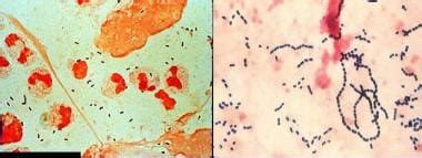 Many Gram Positive Cocci In Sputum Culture