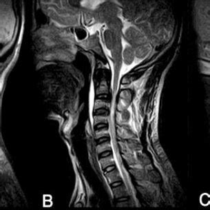 MRI cervical T1, T2 and FLAIR sagittal images showing calcified ...