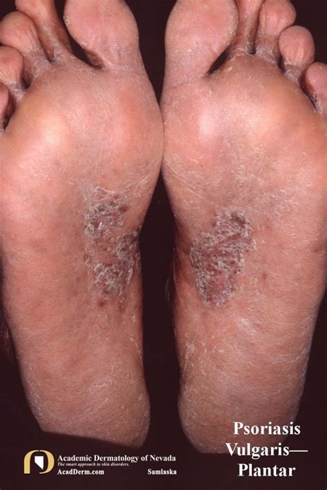 Psoriasis Vulgaris The Basics Academic Dermatology Of Nevada