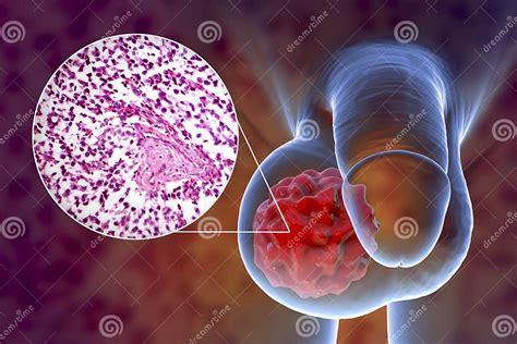 Testicular Cancer 3d Illustration And Light Micrograph Stock