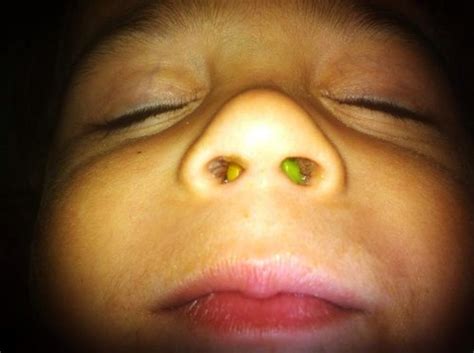 My Toddler Stuck A Pebble Up His Nose Babycenter