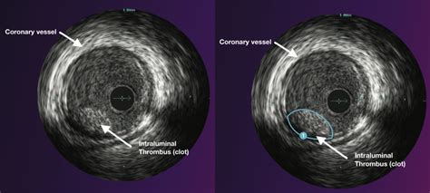 Intra Vascular Ultrasound Ivus Study Sozocardiology Dr Ooi Yau