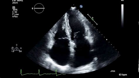 Practice Visual Estimation Of Left Ventricular Ejection Fraction Atrial Fibrillation