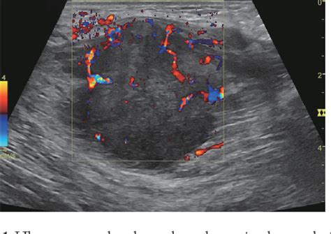 Figure From Skeletal Muscle Metastasis From Squamous Cell Lung Cancer