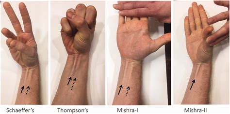 Palmaris Longus Test