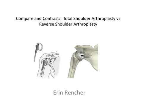 Ppt Compare And Contrast Total Shoulder Arthroplasty Vs Reverse Shoulder Arthroplasty