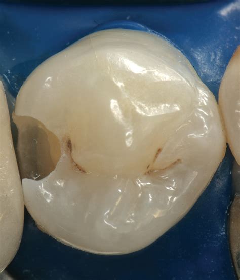 Esthetics Composite Resin Restorations A Simplified Approach June