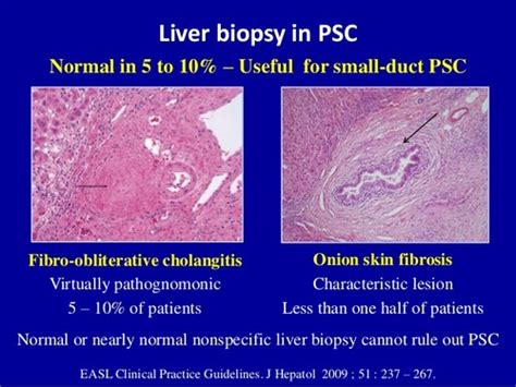 Primary Sclerosing Cholangitis Histology