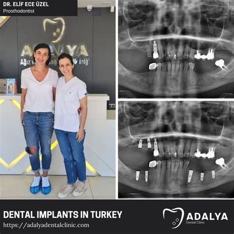 Dental Implants Turkey Antalya Dental Clinic Antalya