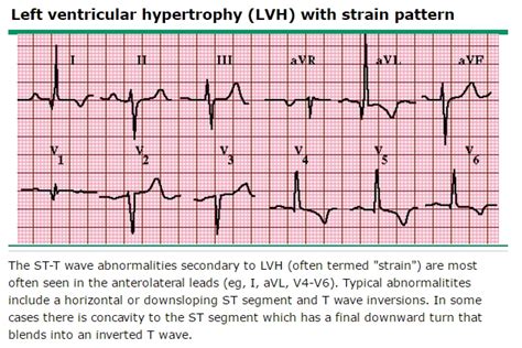 비후성 심근병증 Hypertrohic Cardiomyopathy 네이버 블로그