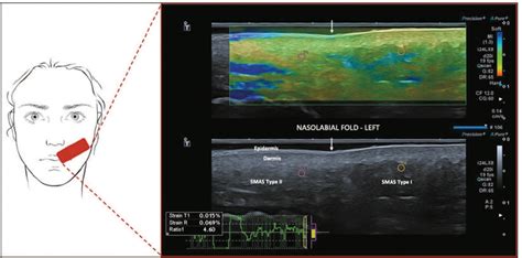 Scielo Brazil U Smas Ultrasound Findings Of The Superficial