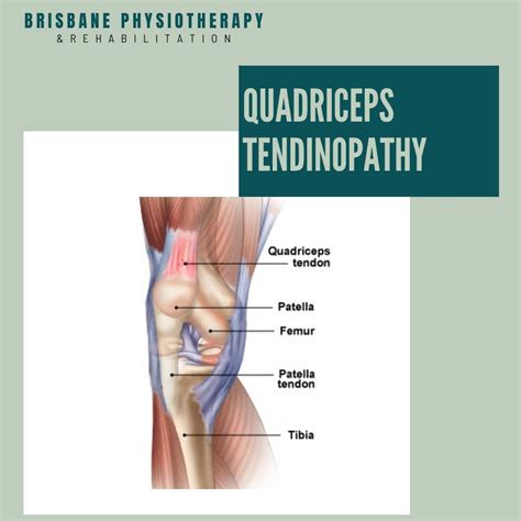 What Is Quadriceps Tendinopathy Brisbane Physiotherapy