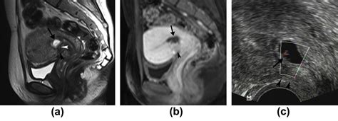 First Trimester Caesarean Scar Ectopic Pregnancy Evaluation Using Mri