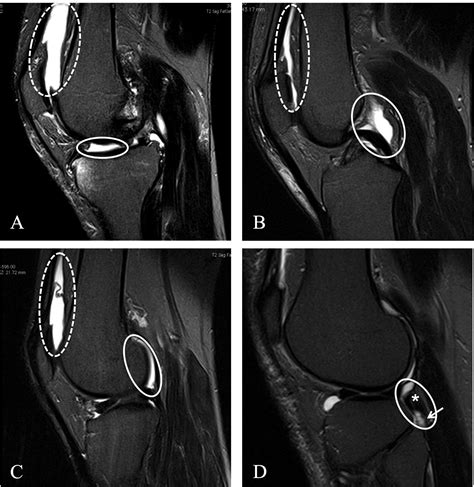 Cross Sectional And Longitudinal Associations Between Knee Joint