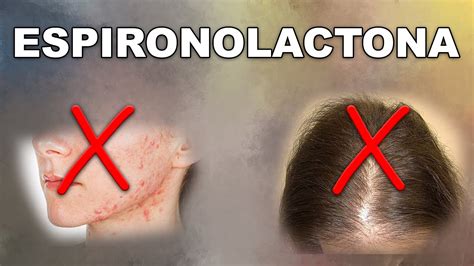 ESPIRONOLACTONA solución ACNÉ y ALOPECIA femenina YouTube