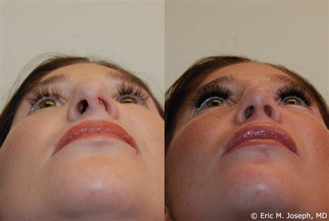 Deviated Septum Surgery Before And After