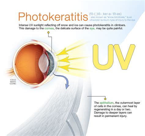 Illustrations Photokeratitis Mayo Clinic Flickr