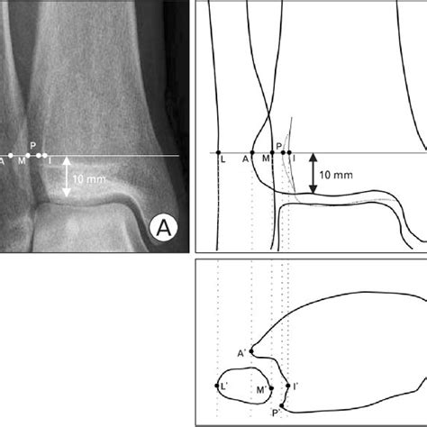 Pdf Radiographic Evaluation Of The Normal Distal Tibiofibular