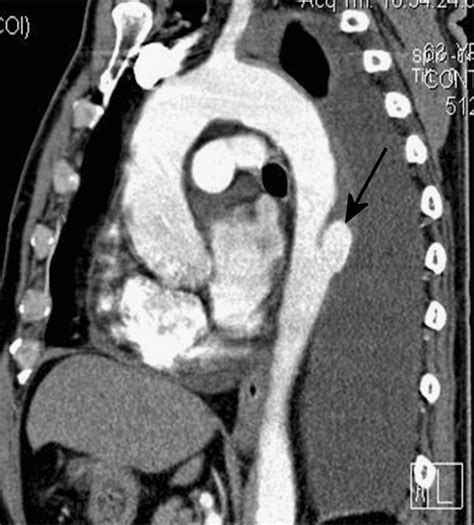 Traumatic Aortic Pseudoaneurysm Sagittal Reformatted Contrast Enhanced Download Scientific