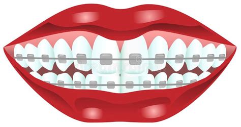 Teeth With Braces Stock Vector Illustration Of Vector 33550130