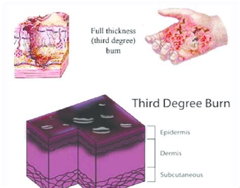 Third Degree of Burn. | Download Scientific Diagram