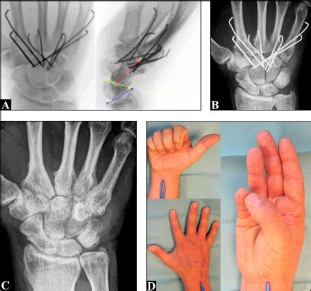 Metacarpophalangeal Joint Dislocation