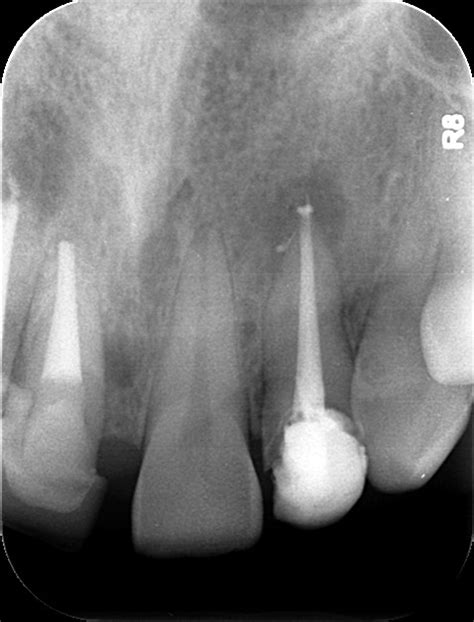 15 Zyste 1 Zahnarzt Dr Med Dent Felix Kehr