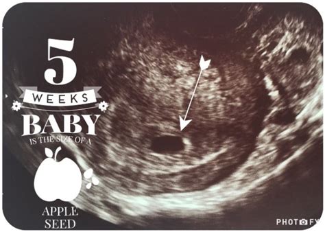 Early Ultrasound (5weeks 5 days) | BabyCenter