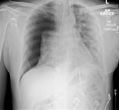 Tracheal Deviation Tension Pneumothorax