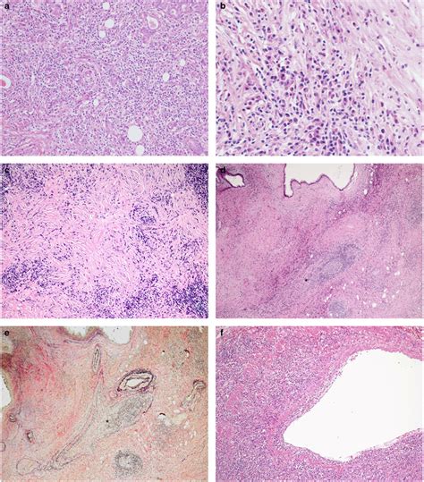 Consensus Statement On The Pathology Of Igg Related Disease Modern