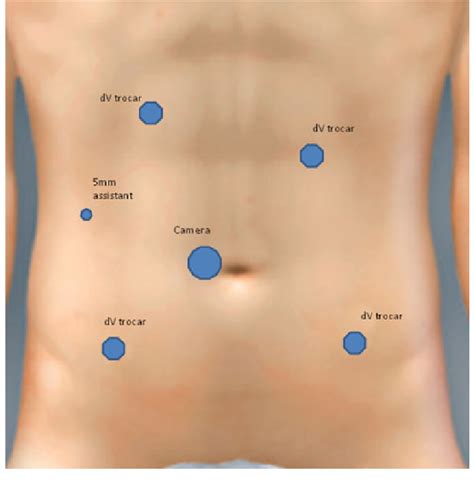 Trocar Placement Position Download Scientific Diagram