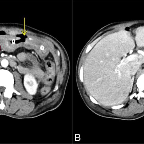 Axial Sections From The Contrast Enhanced Ct Scan Showing Wall Download Scientific Diagram