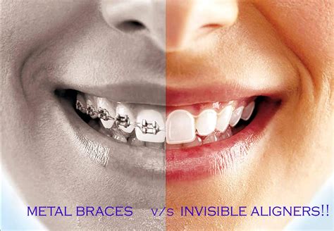 Invisible Aligner At Aed 4999 Best Invisalign Alternative In Dubai