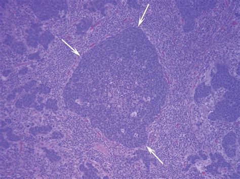 Lymphoepithelioma Like Carcinoma Of The Lung Radiologic Features Of An