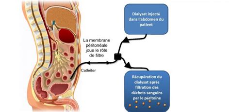 Formation Infirmiere Dialyse Peritoneale Trouver Une Formation Dans