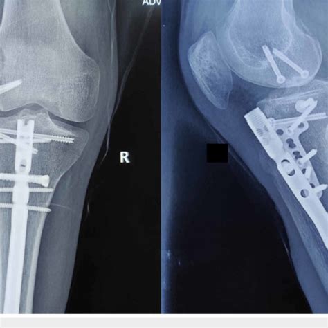 Anteroposterior And Lateral Radiographs Of The Knee At One Year Follow