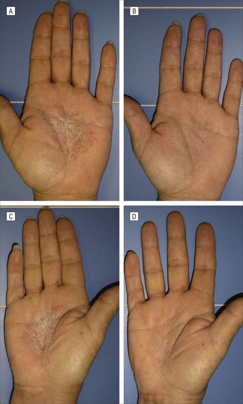 Psoriasis On Hands