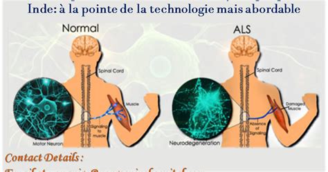 French to India Medical Travel La chirurgie de la sclérose latérale