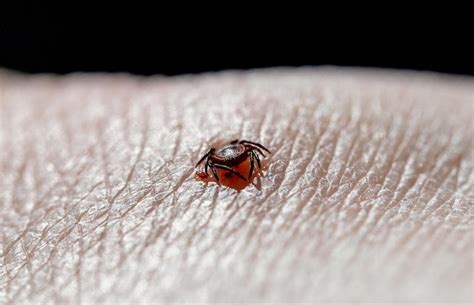 Premium Photo A Tick Embedded In A Person Skin