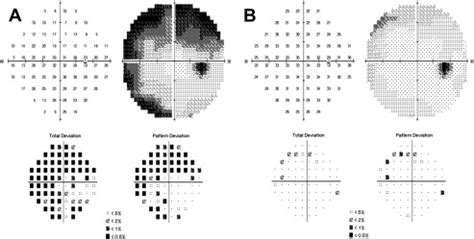 Visual Issues In Multiple Sclerosis Musculoskeletal Key