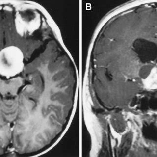 A Axial Contrast Enhanced T Weighted Magnetic Resonance Imaging