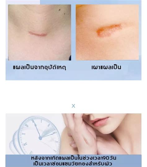 💥ซื้อ 1 แถม 1 💥dermatix ครีมทาแผลเป็น ครีมแผลเป็น เจลซ่อมแซม เจลรอยแผลเป็น รอยแผลเป็น รอยแผลเป็น