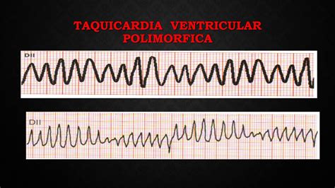 Taquicardia Ventricular Polimórfica