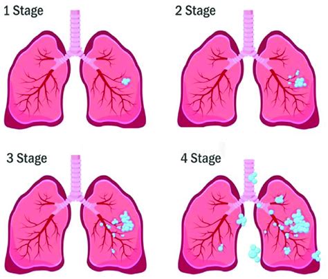 The Four Stages Of Lung Cancer Development Download Scientific Diagram