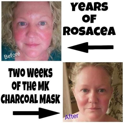 Before And After After Only Two Weeks Charcoalmask Mary Kay Charcoal Mask Selling Mary Kay