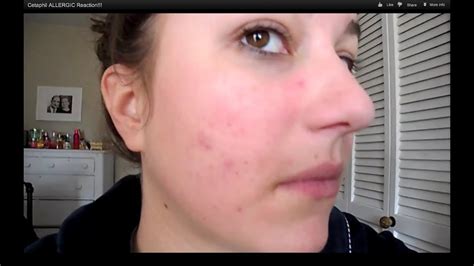 sunscreen allergic reaction - pictures, photos