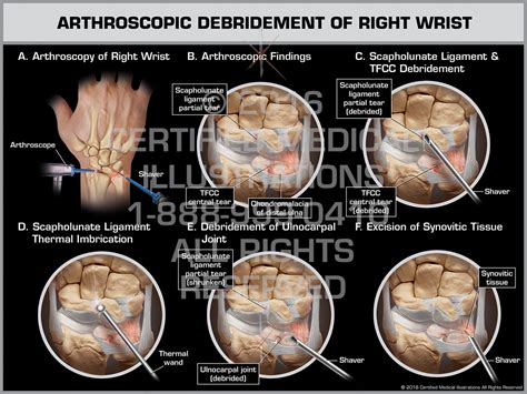 Tfcc Tear Surgery Triangular Fibrocartilage Complex T