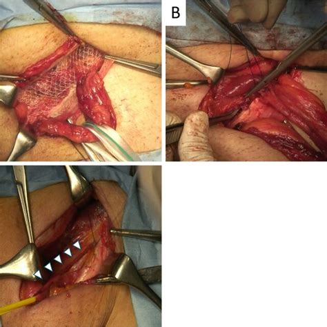 Intraoperative Photography A Modified Lichtenstein Repair Without