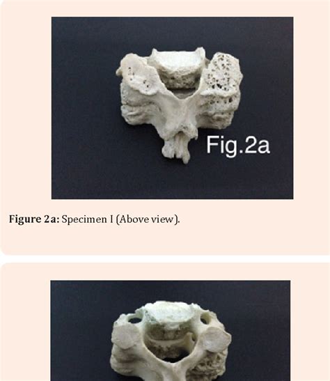 Figure 2 from Congenital fusion of typical cervical vertebrae | Semantic Scholar