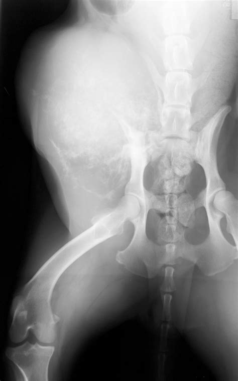 Bone Tumors Pelvic — Dr Julius Liptak